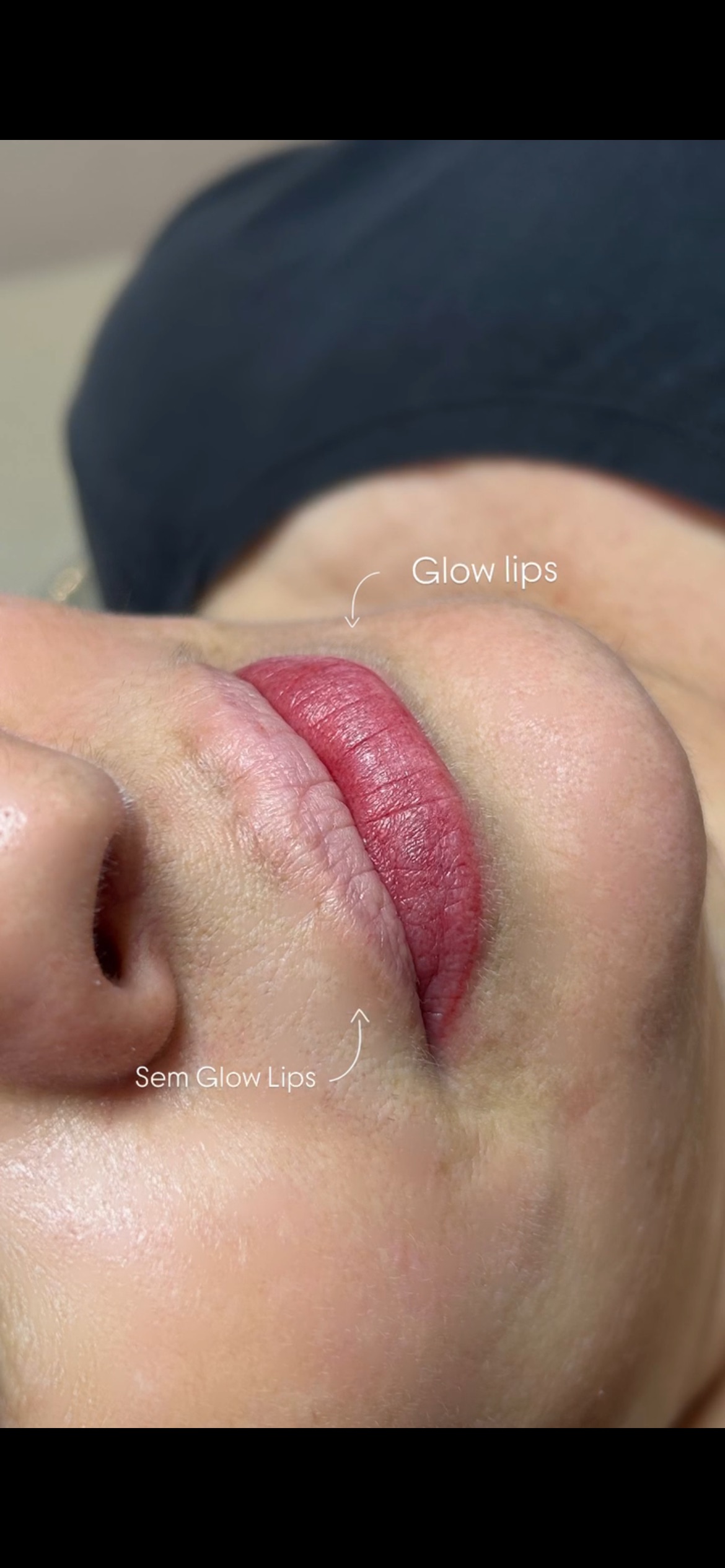 Comparação de resultado Glow Lips
